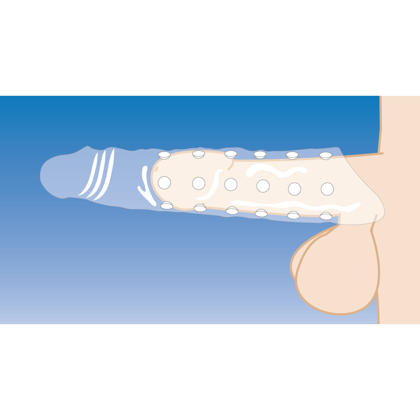 An illustration of a 3-inch clear extender sleeve for enhancement